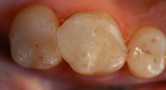 Composite Tooth Colored Filling