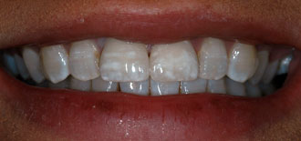 Porcelain Crowns Customized To Match Existing Teeth