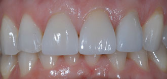 Porcelain Veneers - AFTER