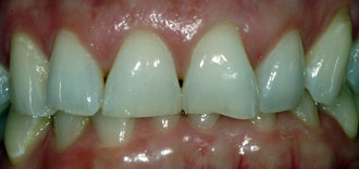 Porcelain Veneers - BEFORE