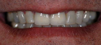 Porcelain Veneers